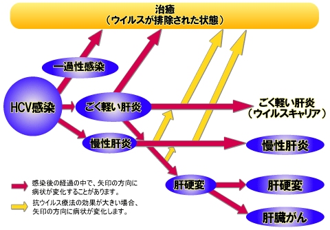 C型肝炎感染後の経過